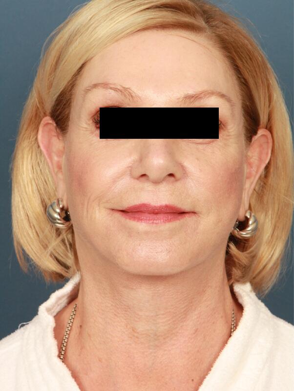 Facelift Before & After Image