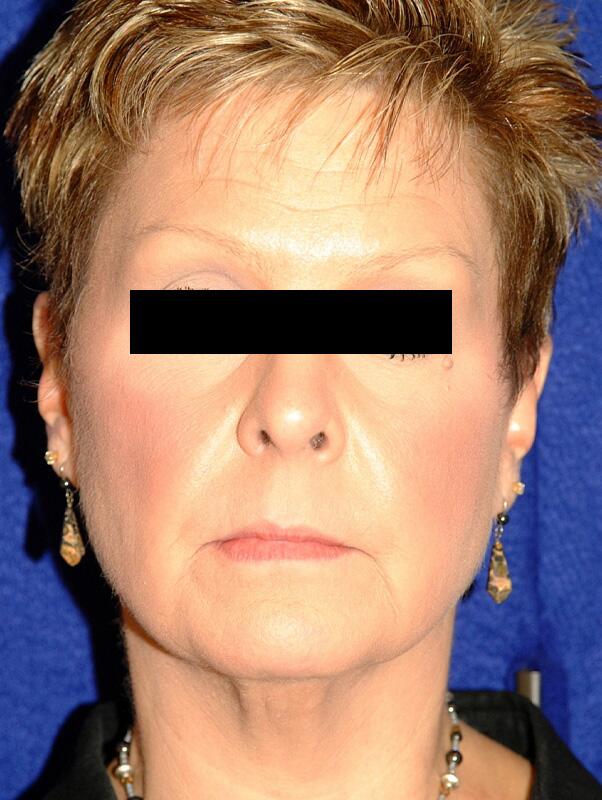 Facelift Before & After Image