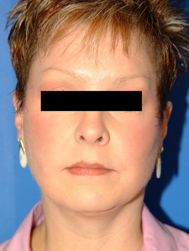 Facelift Before & After Image