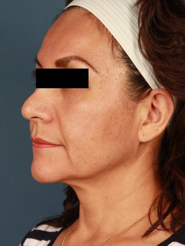 Facelift Before & After Image