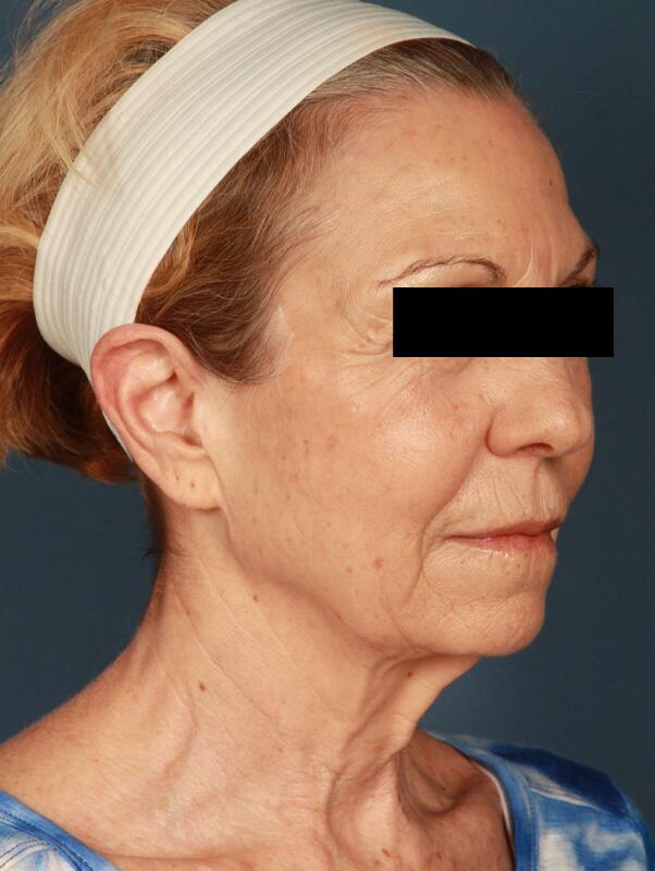 Facelift Before & After Image