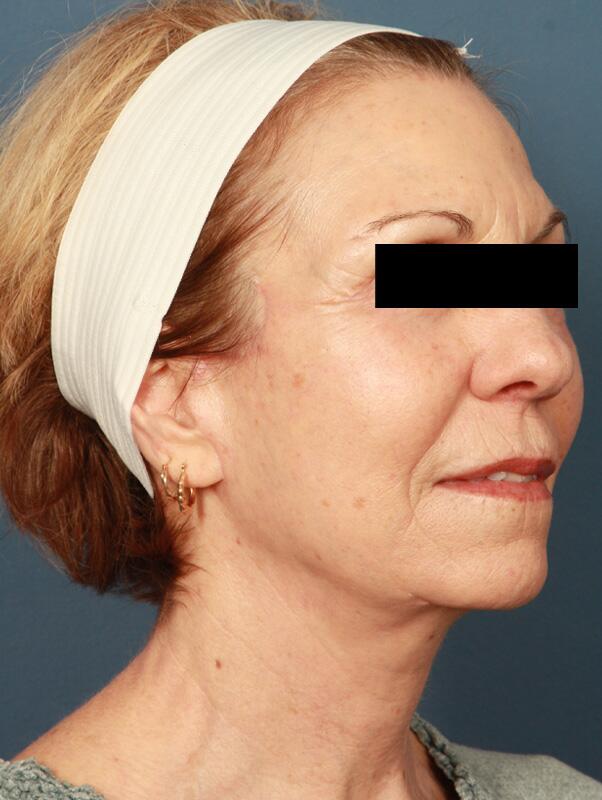 Facelift Before & After Image