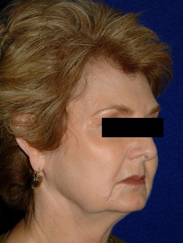 Facelift Before & After Image