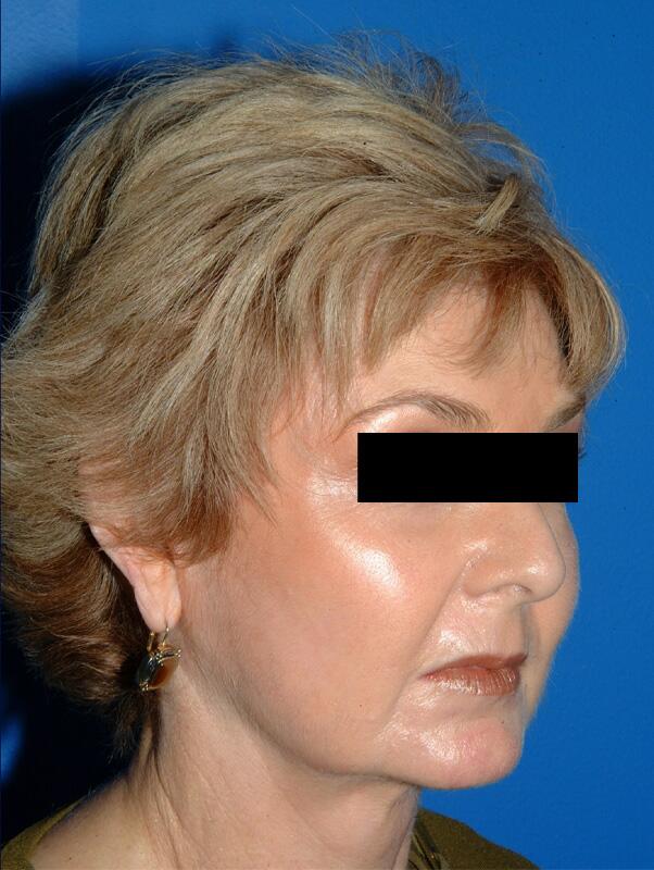 Facelift Before & After Image