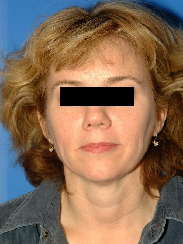 Facelift Before & After Image