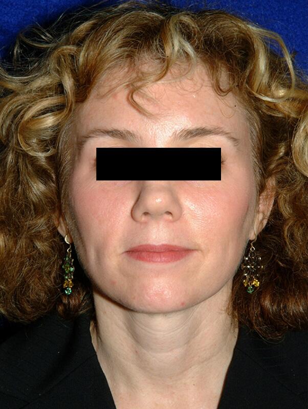 Facelift Before & After Image