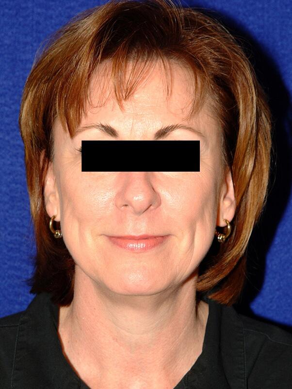 Facelift Before & After Image