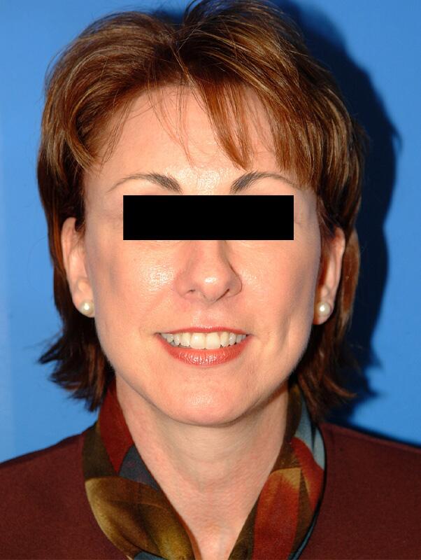 Facelift Before & After Image