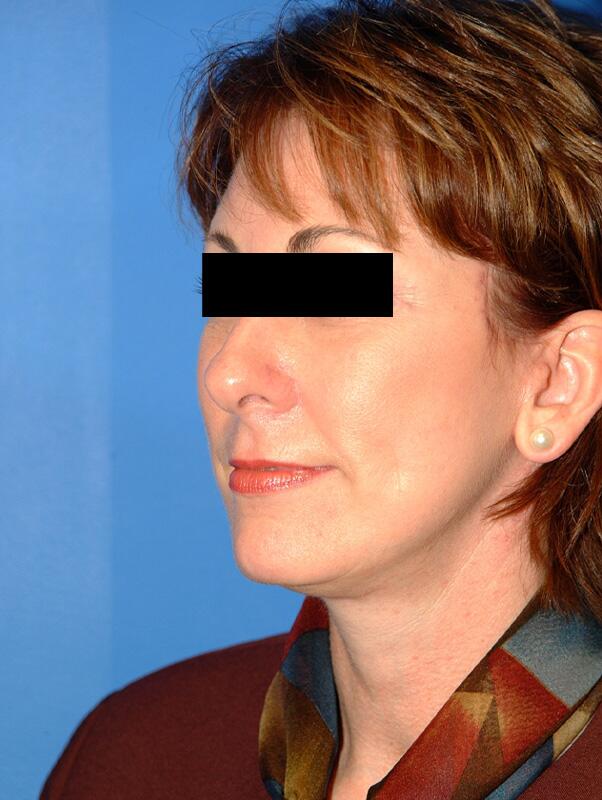 Facelift Before & After Image