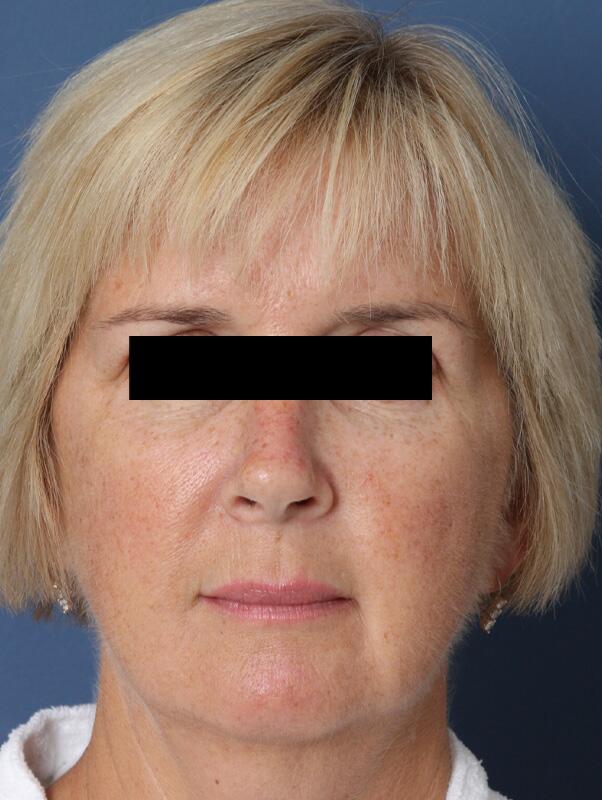 Facelift Before & After Image