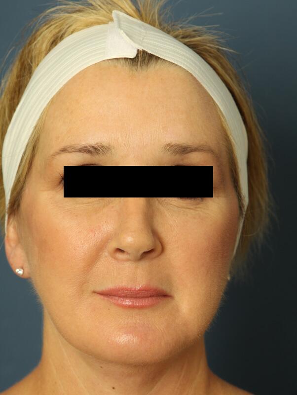 Facelift Before & After Image