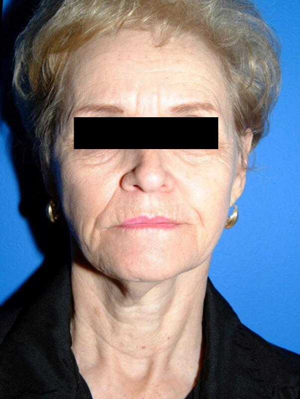 Facelift Before & After Image