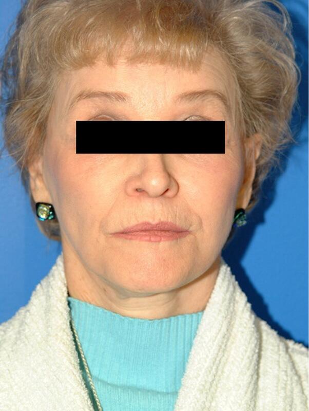 Facelift Before & After Image