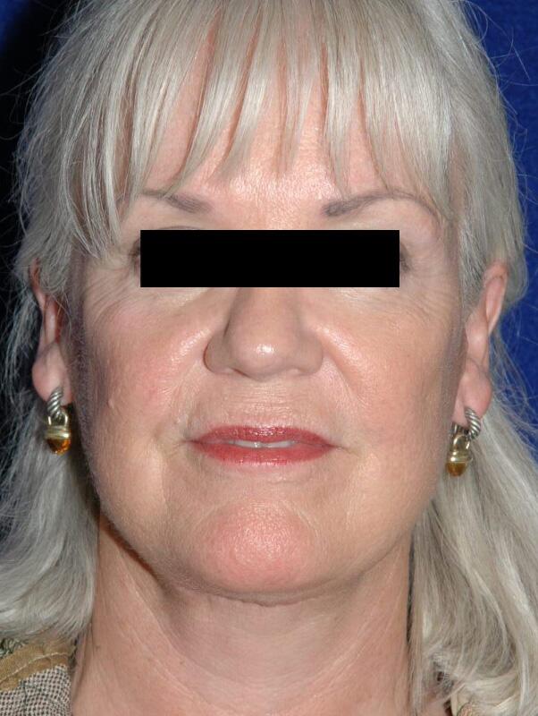 Facelift Before & After Image