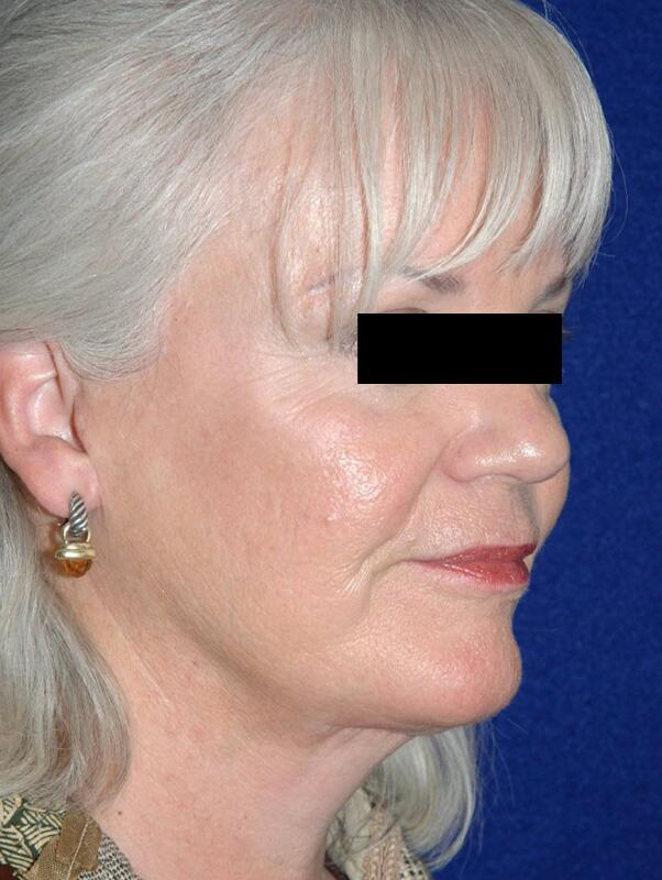 Facelift Before & After Image