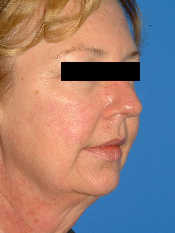 Facelift Before & After Image