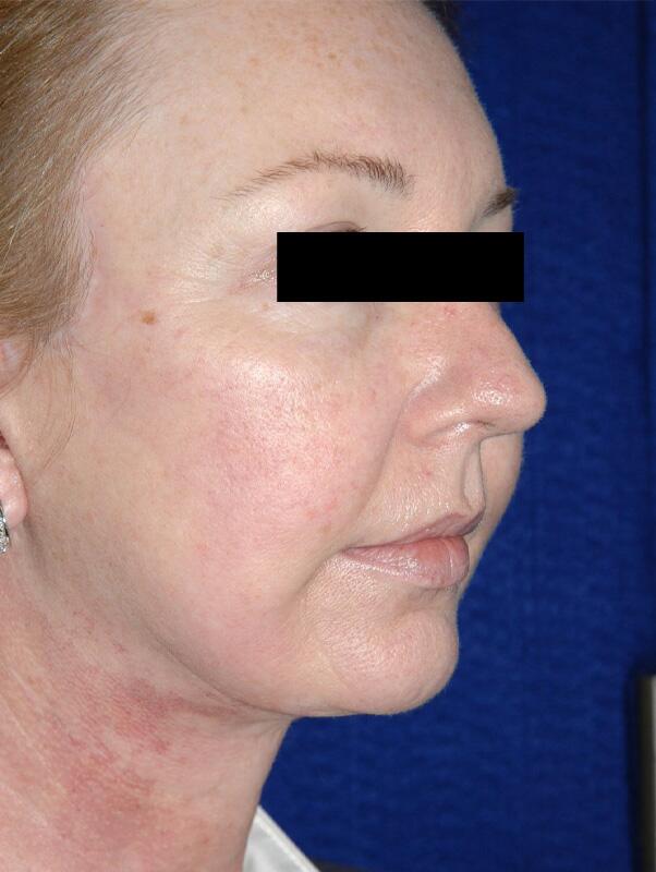 Facelift Before & After Image