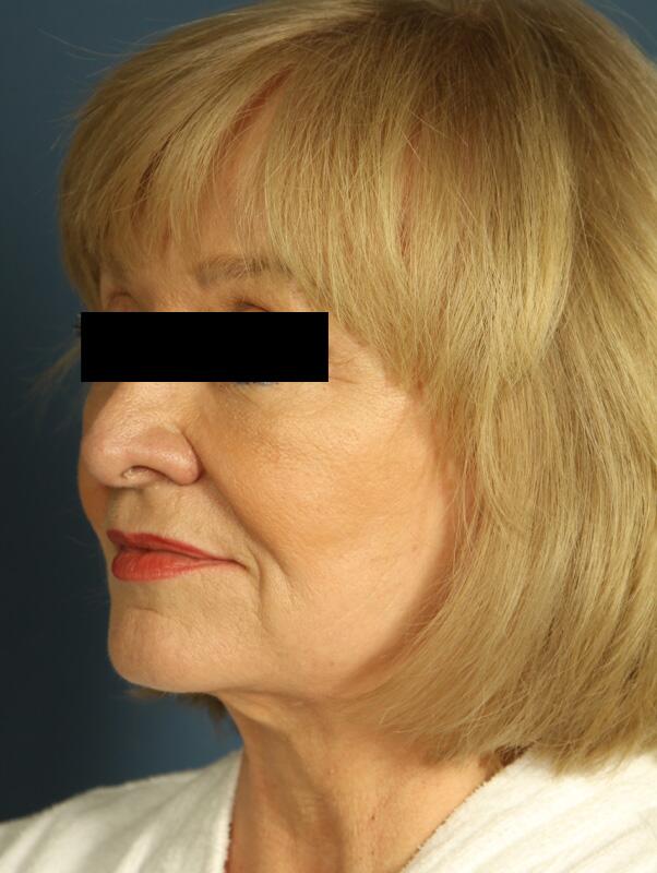 Facelift Before & After Image