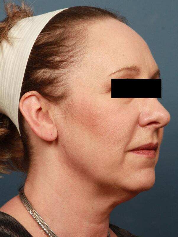 Facelift Before & After Image