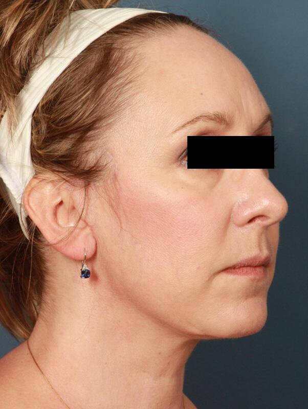 Facelift Before & After Image