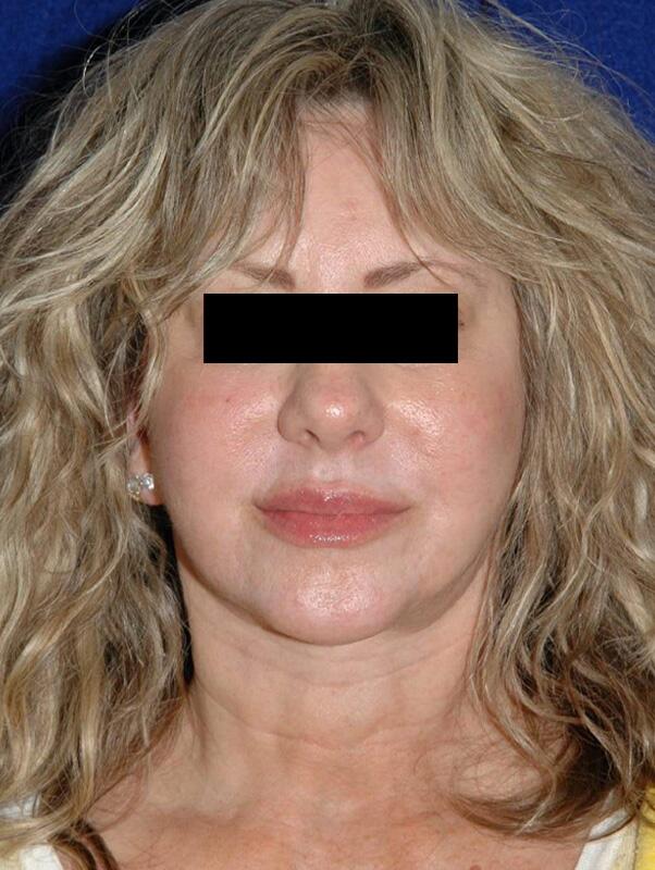 Facelift Before & After Image