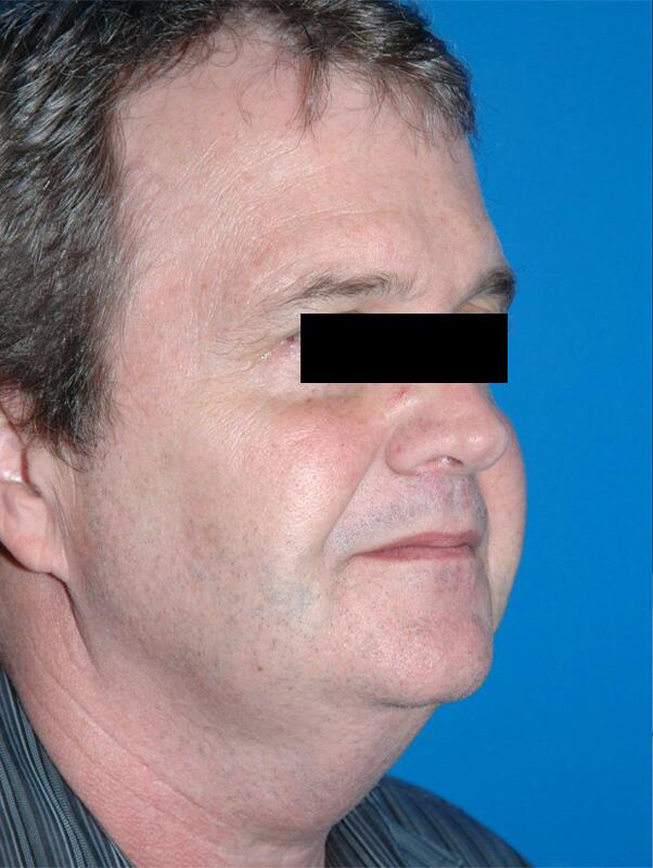 Facelift Before & After Image