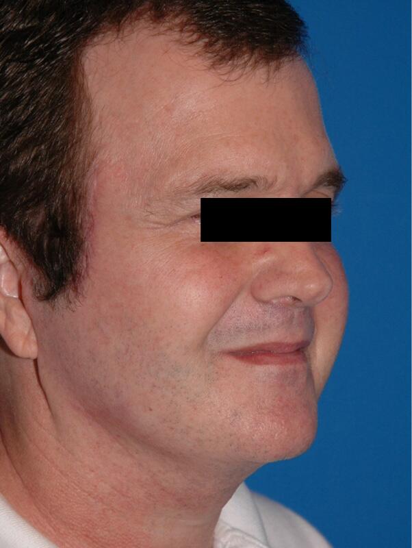 Facelift Before & After Image