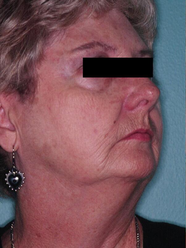 Facelift Before & After Image