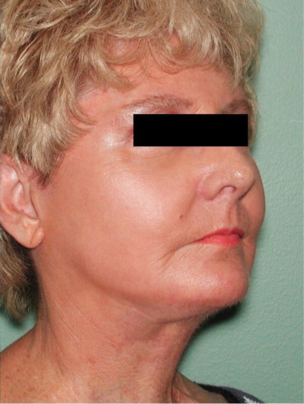 Facelift Before & After Image