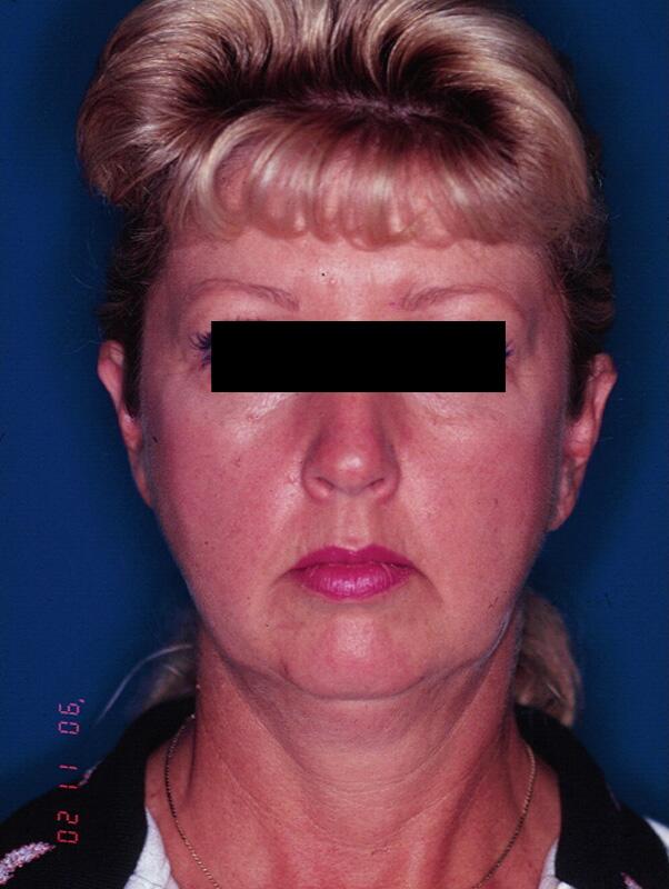 Facelift Before & After Image