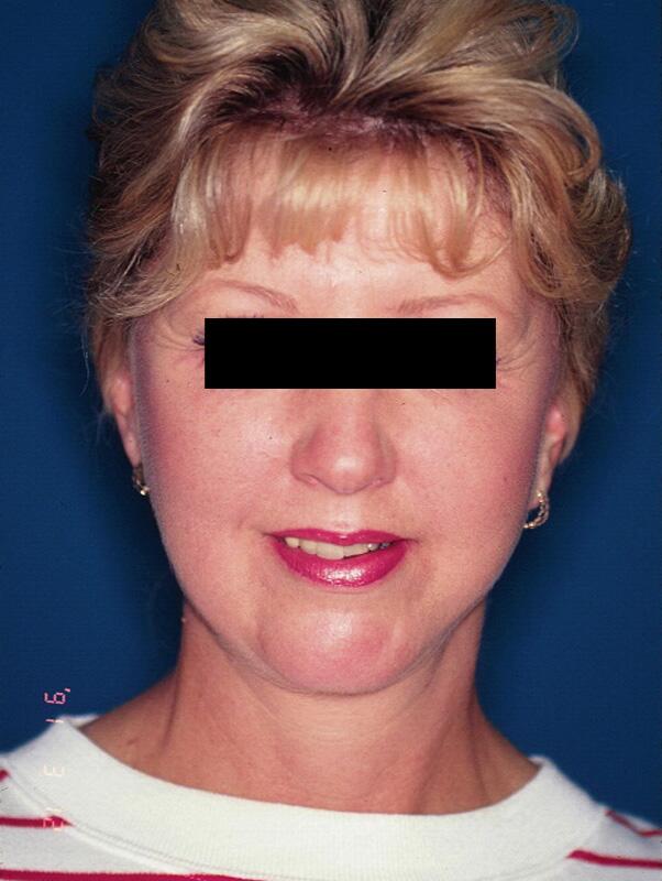 Facelift Before & After Image