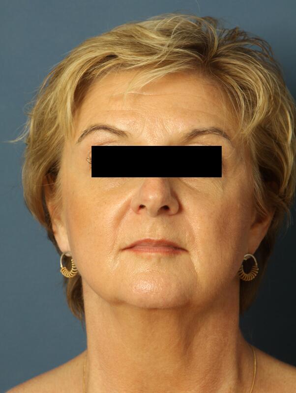 Facelift Before & After Image