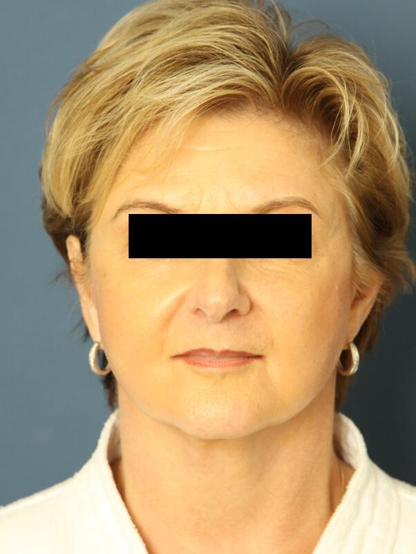 Facelift Before & After Image