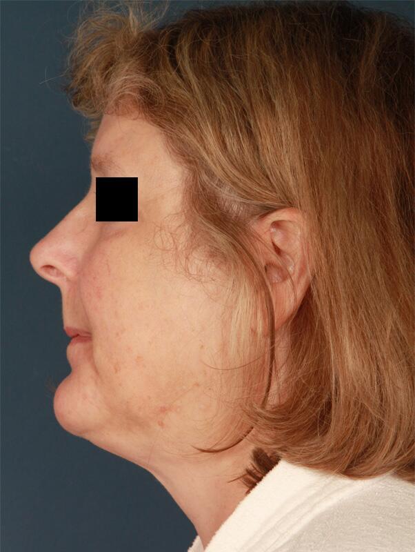 Facelift Before & After Image