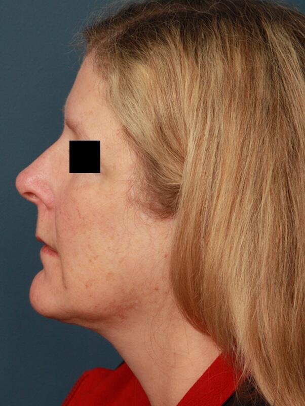 Facelift Before & After Image