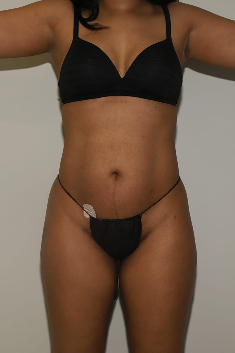 Liposuction Before & After Image