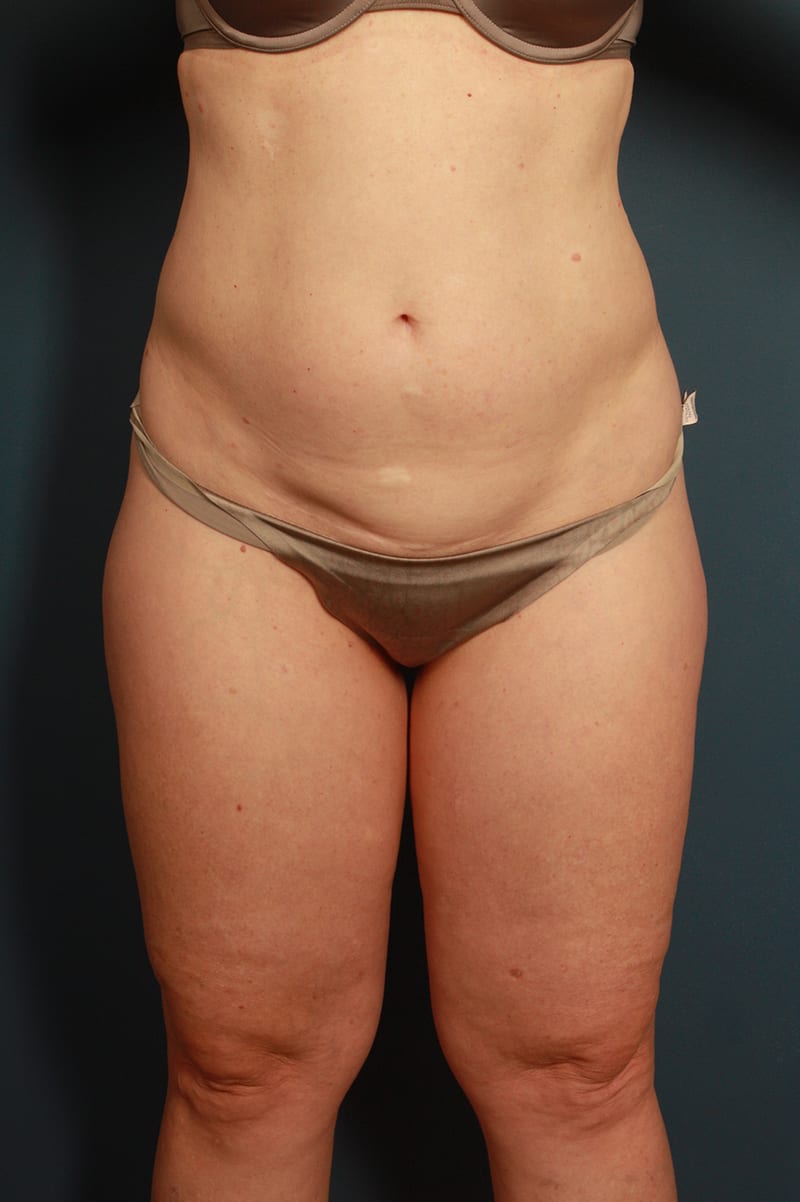 Liposuction Before & After Image