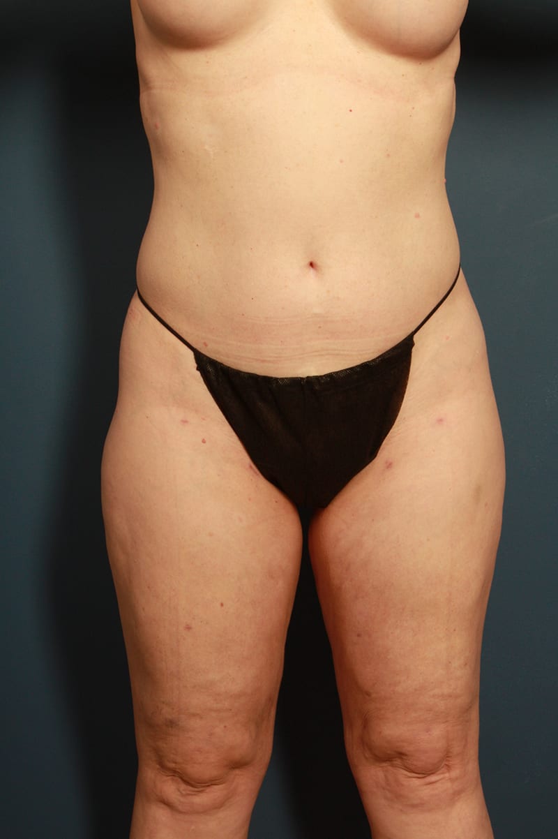 Liposuction Before & After Image