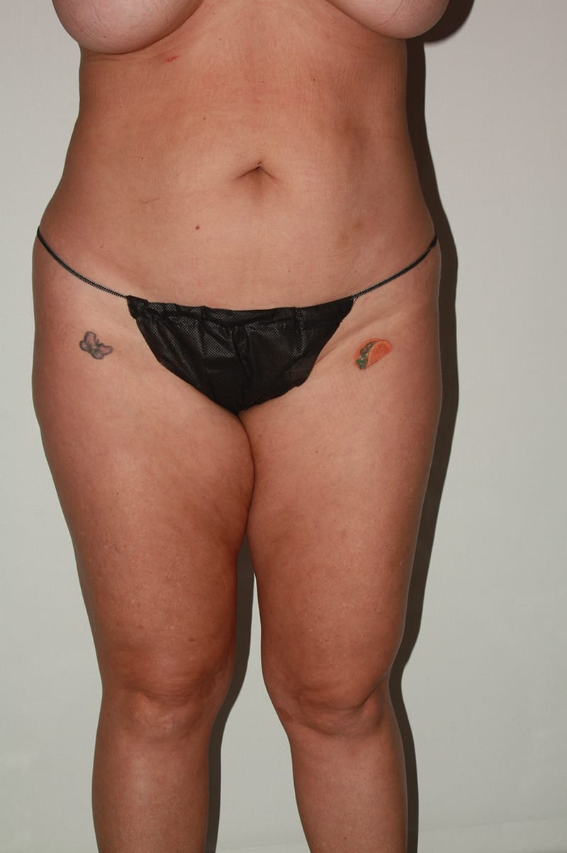 Liposuction Before & After Image