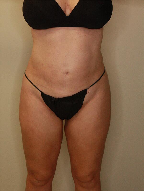 Liposuction Before & After Image