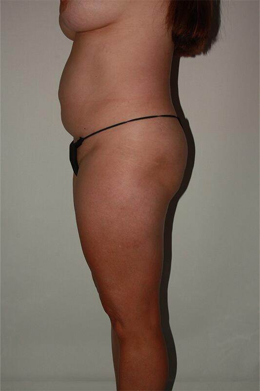 Liposuction Before & After Image