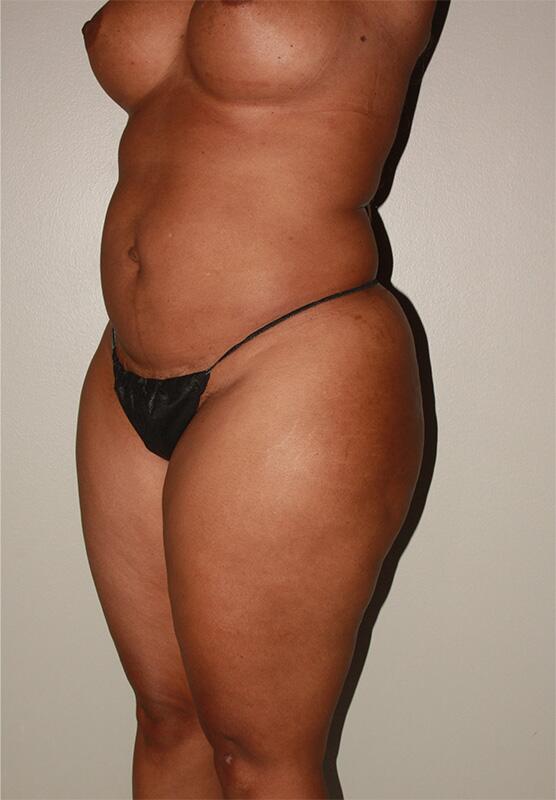 Liposuction Before & After Image