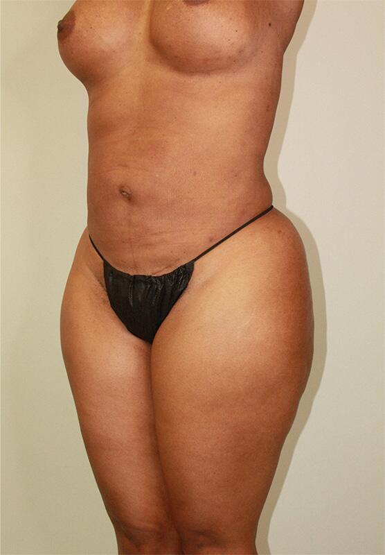 Liposuction Before & After Image