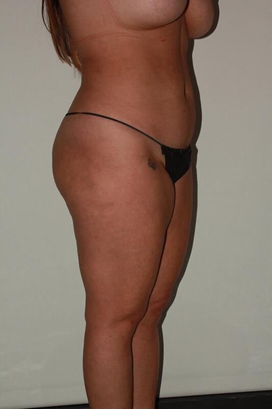 Liposuction Before & After Image