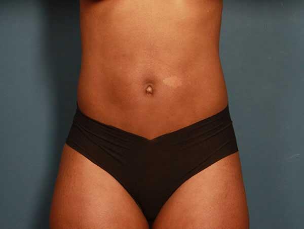 Liposuction Before & After Image