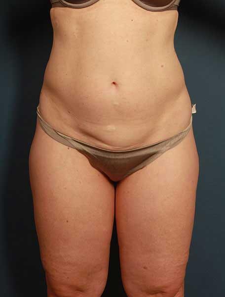 Liposuction Before & After Image