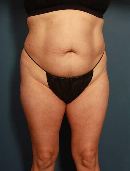 Liposuction Before & After Image