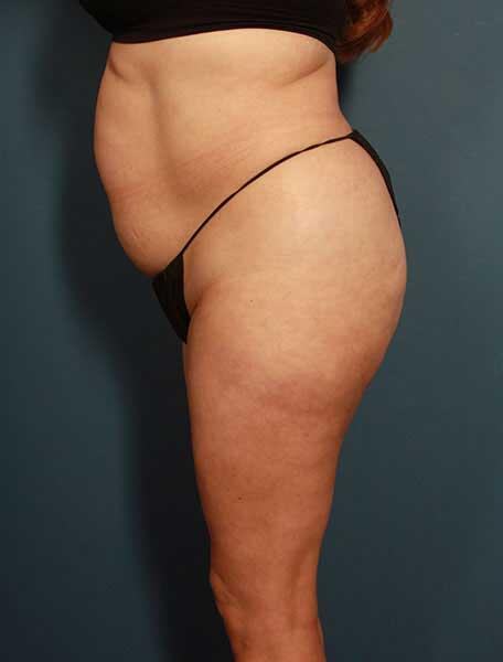 Liposuction Before & After Image