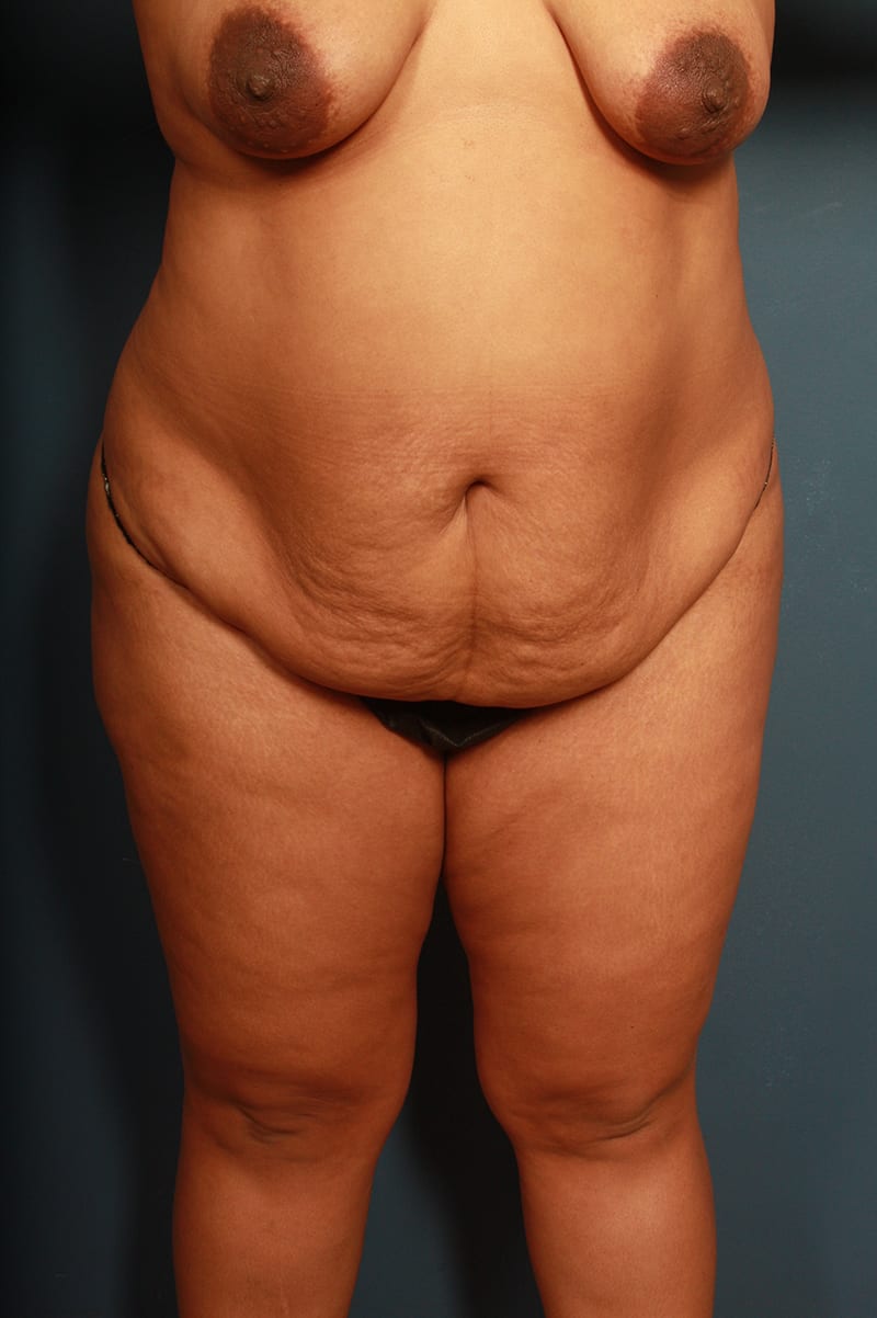 Panniculectomy Before & After Image