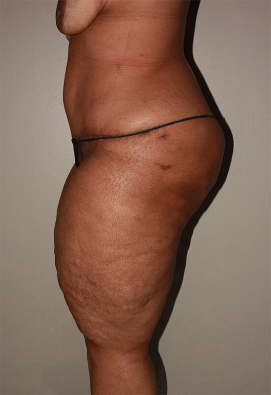 Panniculectomy Before & After Image